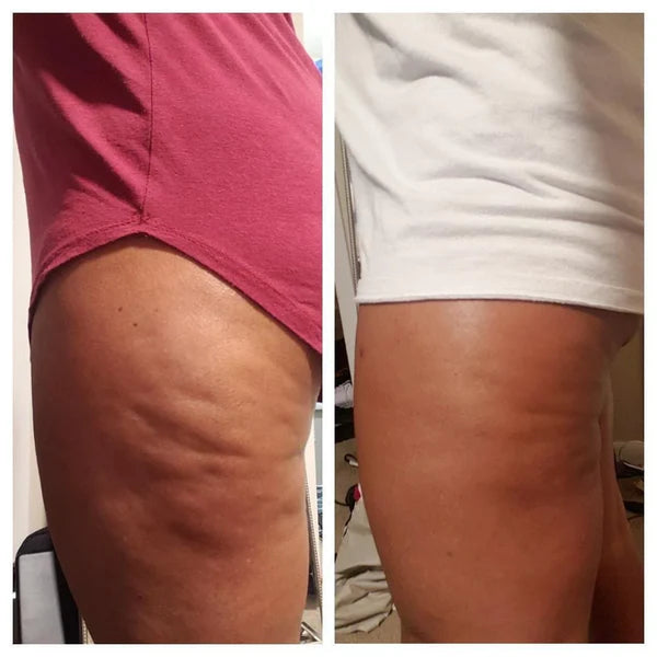 Transforma tu piel con el  Aceite Anticelulítico Natural