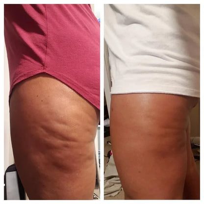 Transforma tu piel con el  Aceite Anticelulítico Natural